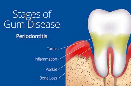 Gum Desease 3D Image
